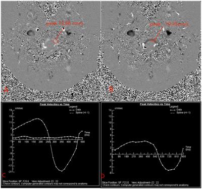 A long-term follow-up study of adults with Chiari malformation type I combined with syringomyelia